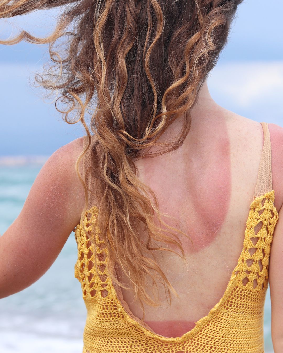 Coup de soleil : les dangers réels pour votre peau